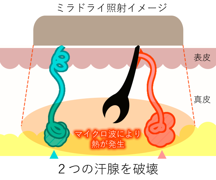 2つの汗腺のイメージ(照射中)