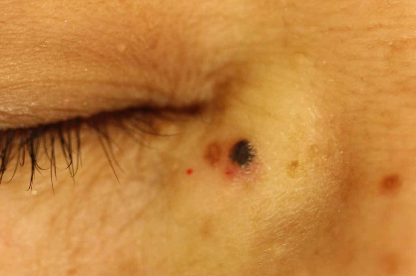 皮膚悪性腫瘍