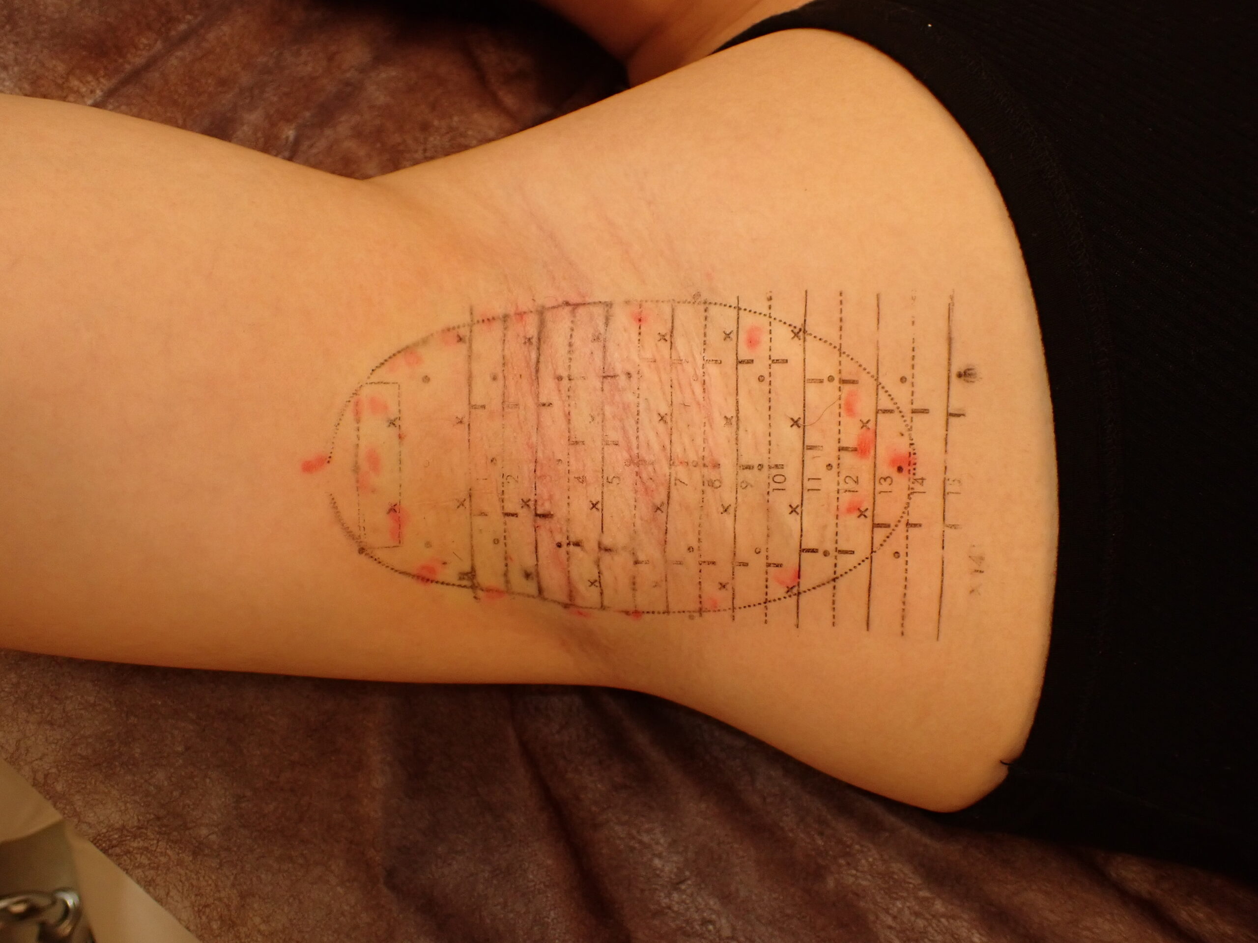 ミラドライのマイクロ波を照射