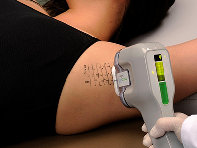 ミラドライを研究している医師が施術します