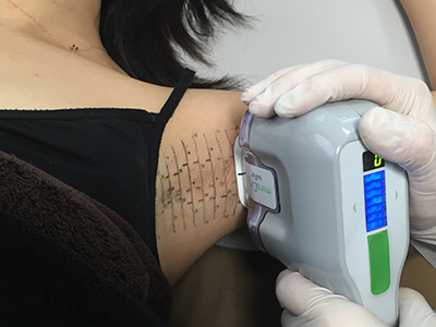 ミラドライのマイクロ波を照射